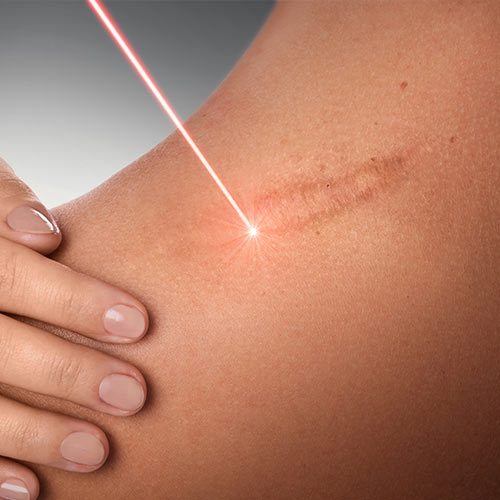 Narbenbehandlung mit Laser vom Experten Dr. Thomas