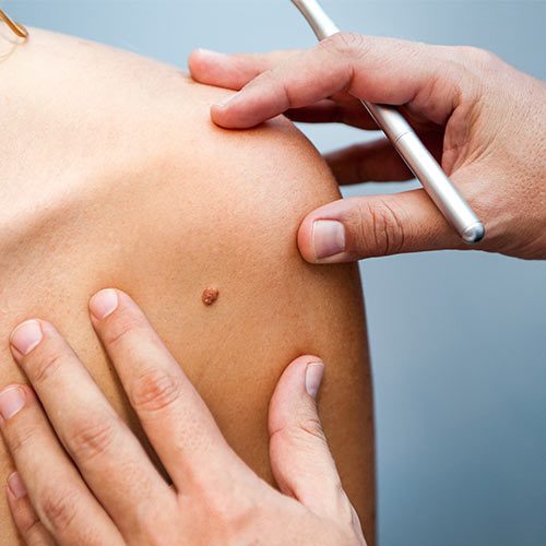 hautarzt-dr-thomas-home-schwerpunkte-muttermal