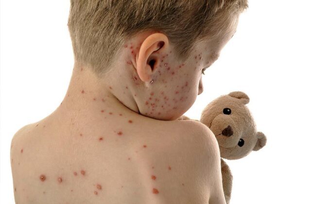 Kind mit Hauterkrankung auf dem Rücken mit Stofftier in Praxis von Dr. Thomas